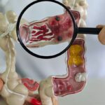 em-13-anos,-doenca-inflamatoria-intestinal-cresce-5-vezes-no-brasil